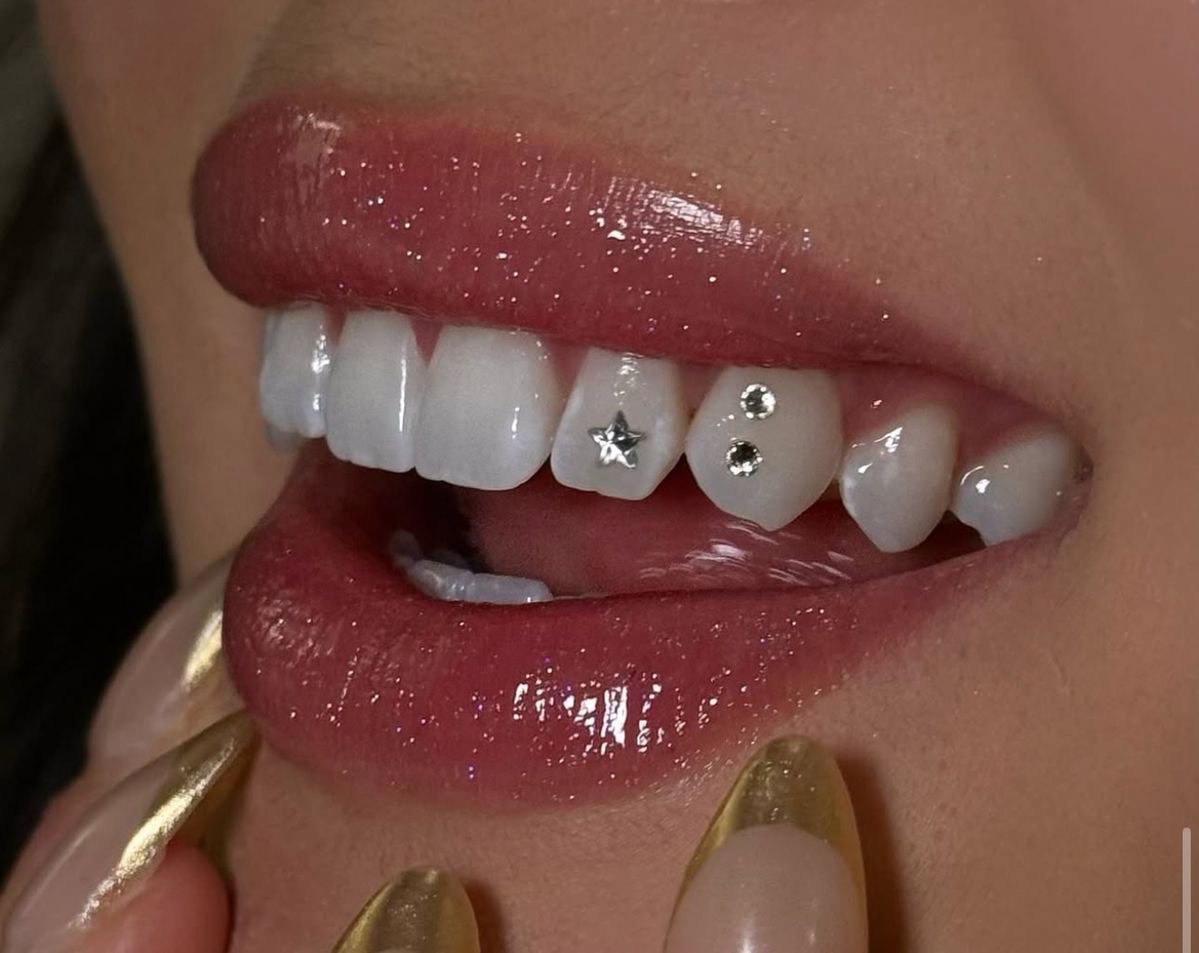 Postavljanje cirkona na zub