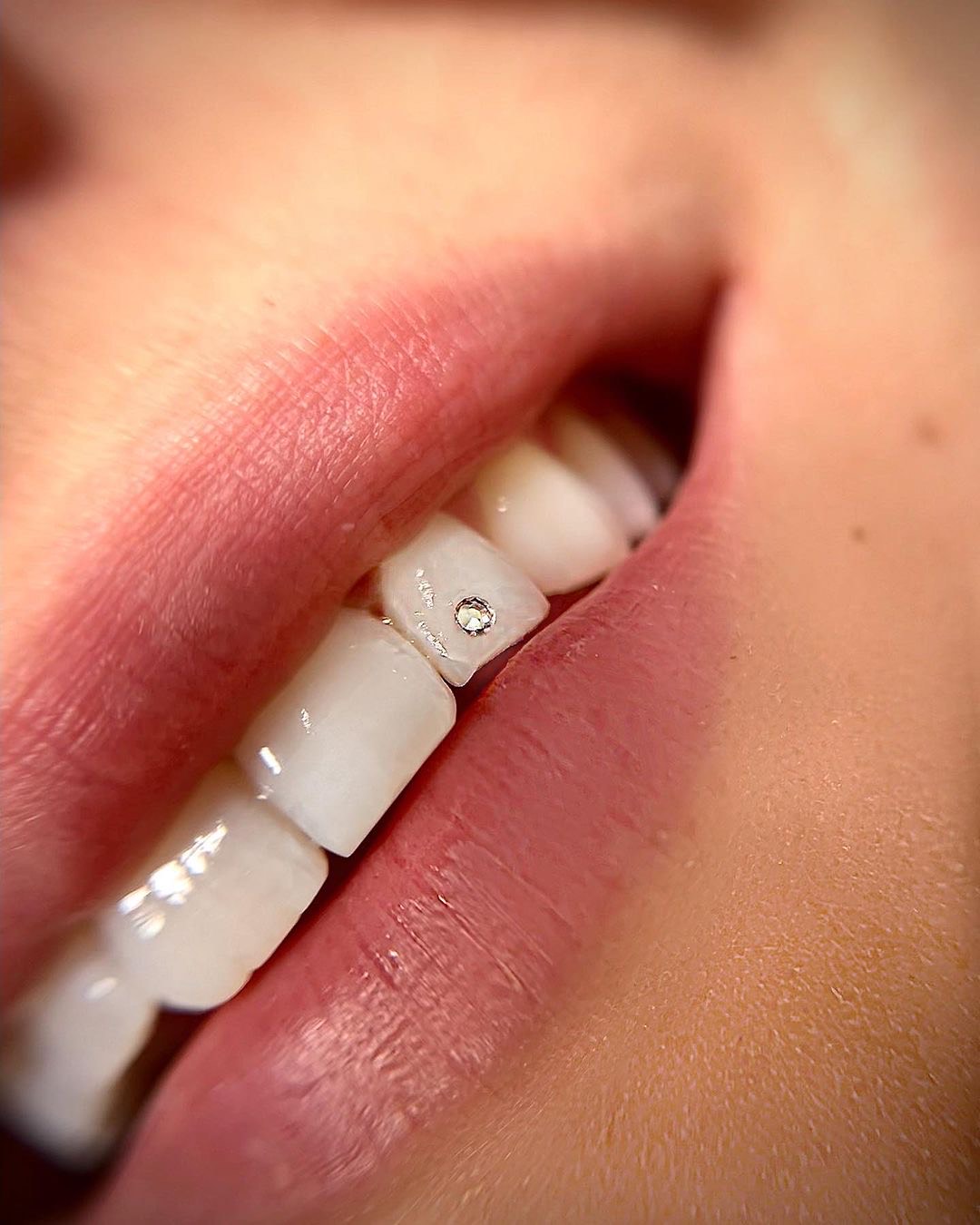 Postavljanje cirkona na zub