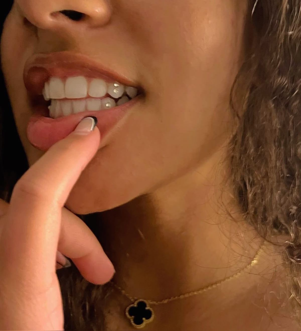 Postavljanje cirkona na zub