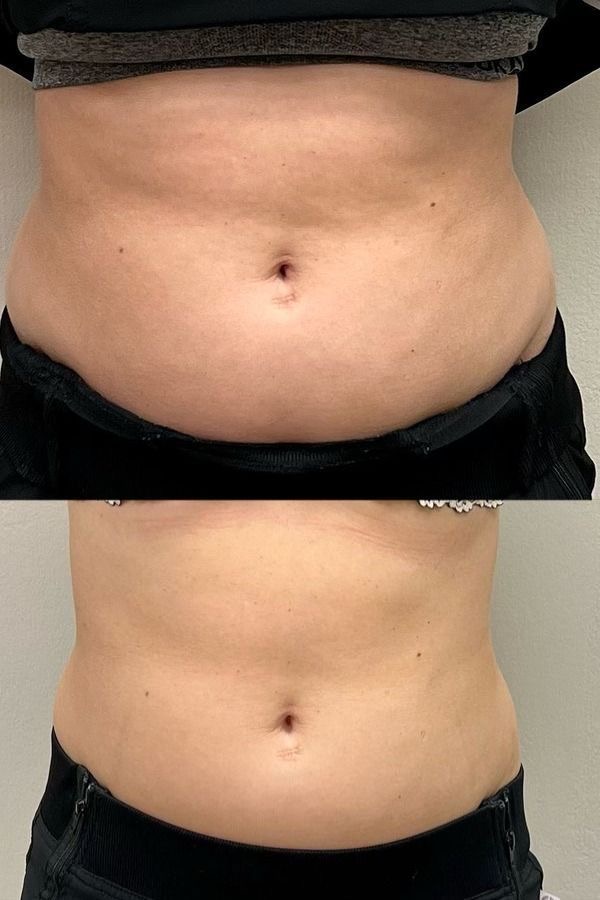 HIFU tretman za tijelo